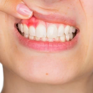 Peridontoloji (Diş Eti Hastalıkları)